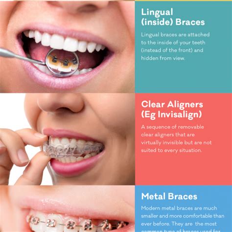 types of braces info straighten teeth without braces | Straighten teeth ...