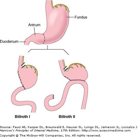 Billroth 1 vs. Billroth | Surgical nursing, Medical mnemonics, Medical jokes