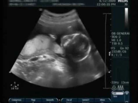 Level 2 Ultrasound - YouTube