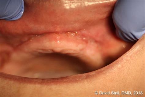 LightScalpel Laser Vestibuloplasty Results - CO2 Laser Dentistry