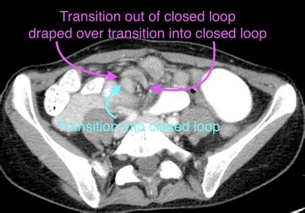 Closed loop obstruction | Radiology Reference Article | Radiopaedia.org