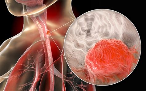 A Closer Look at Metformin and Esophageal Squamous Cell Carcinoma ...