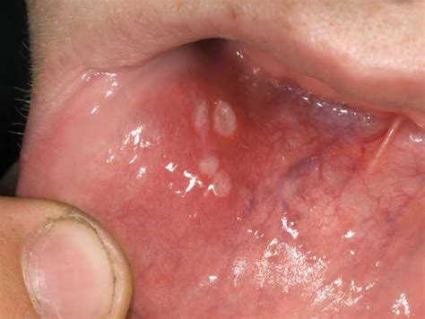 Stomatitis - Types, Symptoms, Causes & Treatment