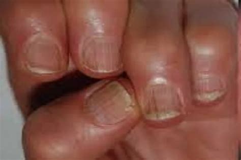 Fingernail ridges: what causes furrows on the nails, and how to get rid of them - Afrinik