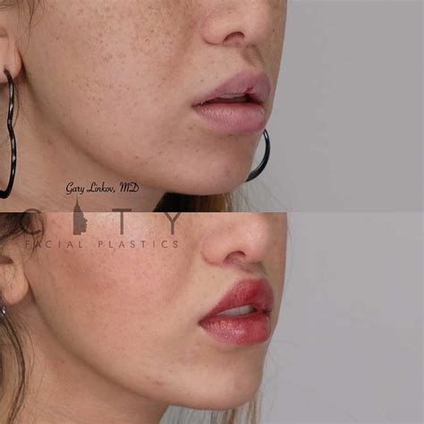 NYC Lip Lift Revision Surgery | UES Lip Lift Scar Repair | Cosmetic Surgery