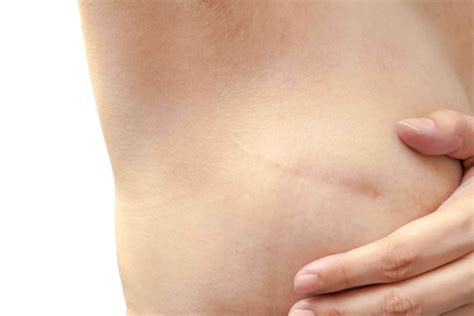 Scarring and Breast Cancer Treatments