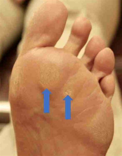 Ball of Foot Pain. Causes, Symptoms, Treatment & Insoles