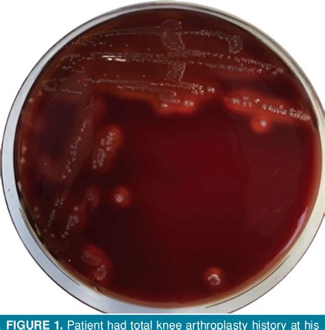 Figure 1 from Periprosthetic joint infection with streptococcus dysgalactiae subspecies ...