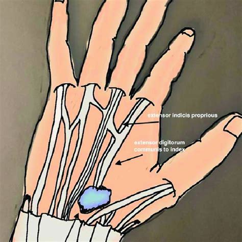 a schematic demonstrating the synovial cyst arising from the extensor ...