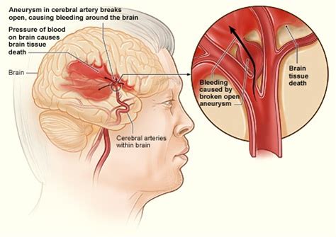 Stroke - Causes and Risk Factors | NHLBI, NIH