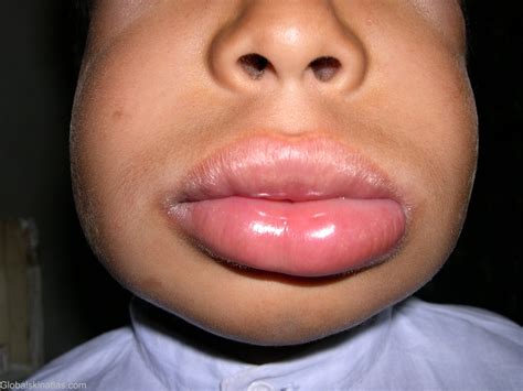 Angioedema Of The Lips Pictures | Lipstutorial.org