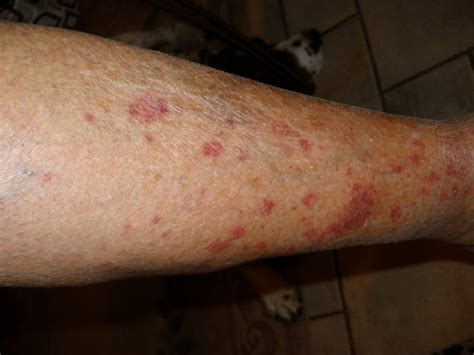 Red Dots on Legs - Pictures, Symptoms, Causes, Treatment