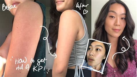 HOW I CLEARED MY KP (KERATOSIS PILARIS) & ACNE | Before & After - YouTube