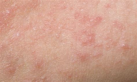 Contact Dermatitis - Symptoms, Treatment, and More