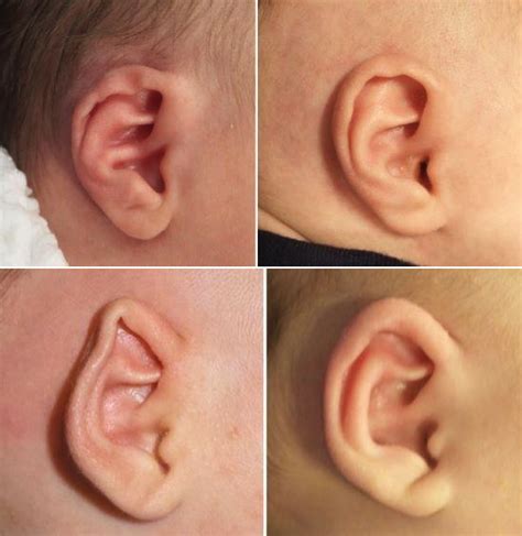 Ear Molding in Northern New Jersey: Correcting Newborn Ear Deformities ...