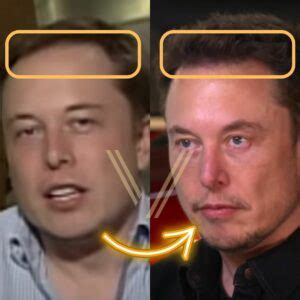 Elon Musk's Hair Transplant: Before and After Transformation