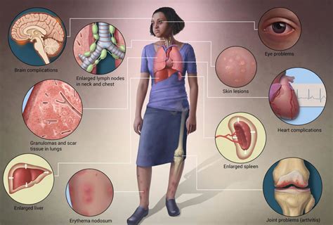 Sarcoidosis - Causes, Stage, Signs, Symptoms, Diagnosis & Treatment