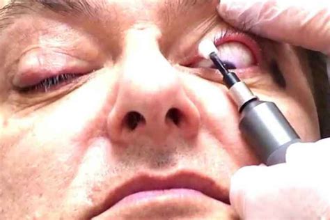 Eyelashes Infested With Mites | Demodex Mites | Eye Mites