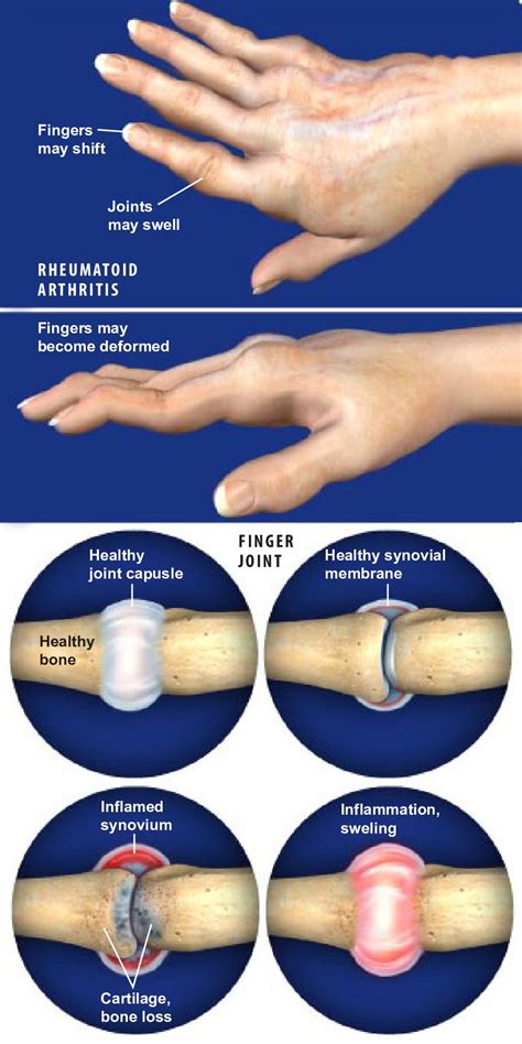 Rheumatoid Arthritis (RA) of the Hand (Arthritis Foundation Approved ...