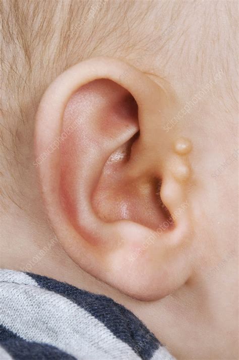 Accessory auricle - Stock Image - C029/6460 - Science Photo Library