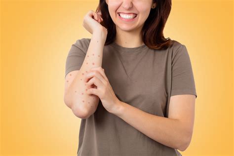 11 Natural Home Remedies To Get Rid Of Scabies - Healthwire