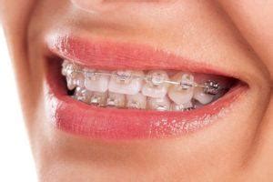 Should You Consider Using Whitening Strips After Braces? - iBreathBad