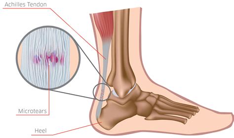 Best Tips About How To Heal Foot Tendonitis - Dugdrive82