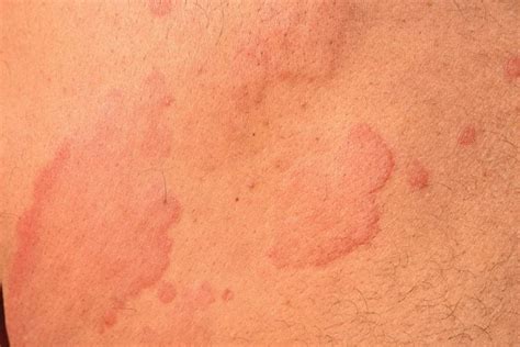 What Causes Hives? What You Should Know About Urticaria | The Healthy