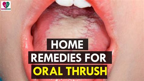 Home Remedies for Oral Thrush - health Sutra - YouTube