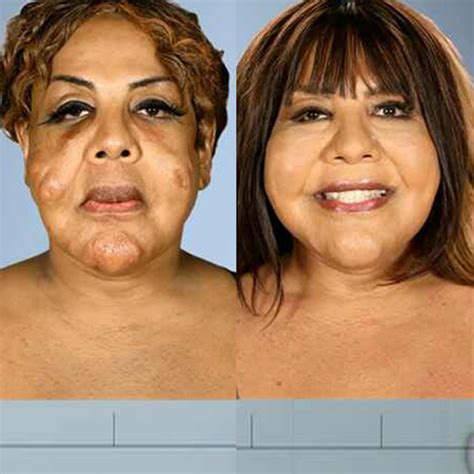 Photos from Botched Patients Before and After: Shocking Transformations ...