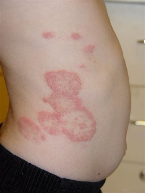 Tinea Corporis - Symptoms ,Causes ,Diagnosis and Treatment