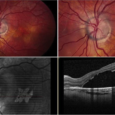 (PDF) Oral acetazolamide as a medical adjuvant to retinal surgery in optic disc pit maculopathy ...