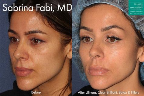 Botox To Lift Sagging Eyebrows | San Diego, CA | CLDerm