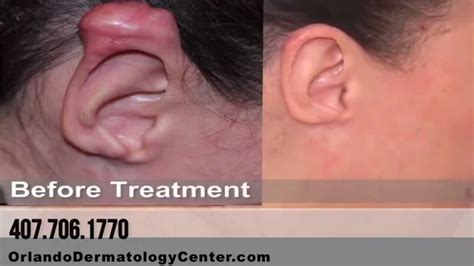 Keloid Removal: Cryoshape Procedure to Freeze and Remove Keloids - YouTube