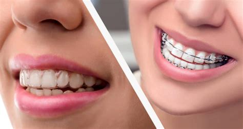 Can You Get Invisalign After Braces? | Stanley Dentistry