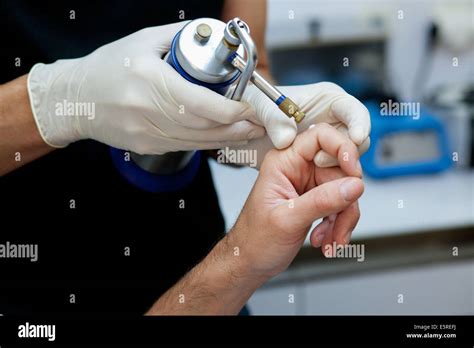 Dermatologist treating a wart with liquid nitrogen Stock Photo - Alamy