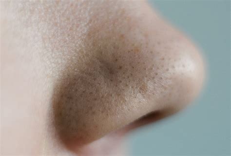 Clogged Pores: Home Remedies and Treatment Options