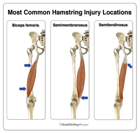 Tendinitis Information and Treatments