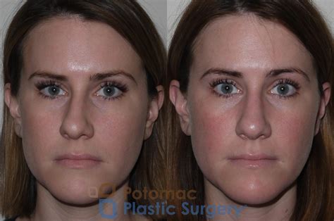 Rhinoplasty - Cosmetic Before & After Photos Patient 128 | Washington ...