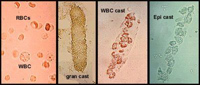 Wbc Casts In Urine