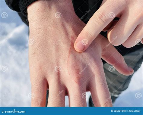 Scratch on a Hand, Close Up Stock Photo - Image of scratch, deep: 226321048