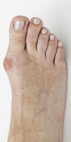 Foot Bunion Surgery Canberra Minimally Invasive Removal