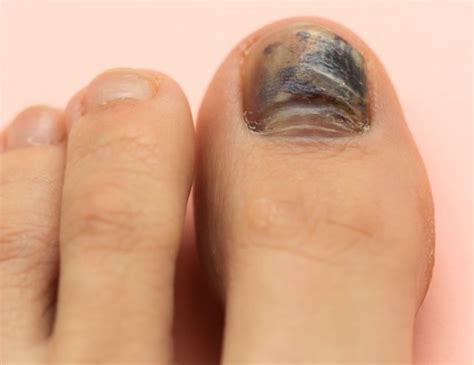 What Causes Thick Black Toenails - Nail Ftempo