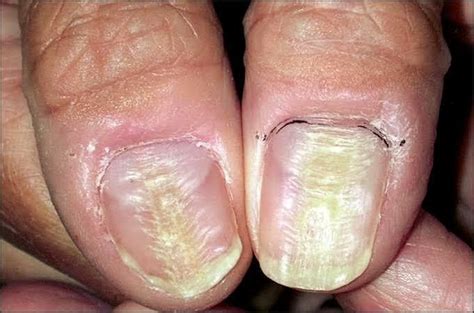 Nail Abnormalities