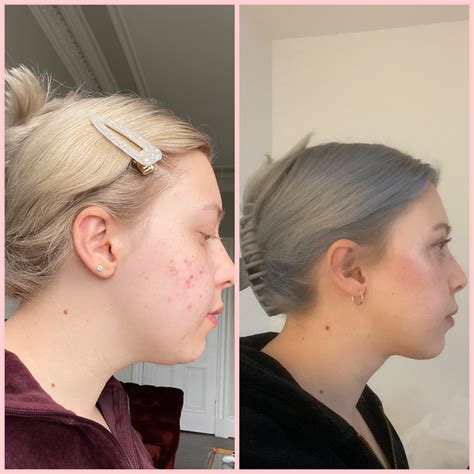 Chin Lipo Before & After (4 months post op) : r/PlasticSurgery