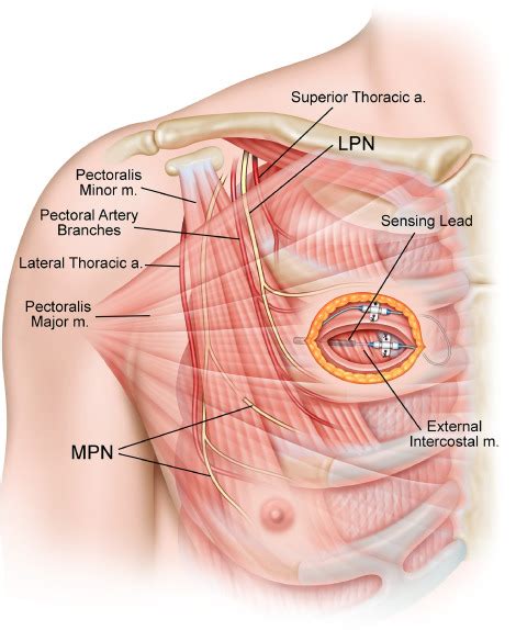 Hypoglossal nerve stimulator implantation via a 2-incision technique - Operative Techniques in ...