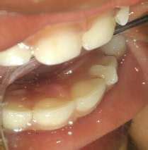 -Talon cusp on the palatal surface of 52. | Download Scientific Diagram