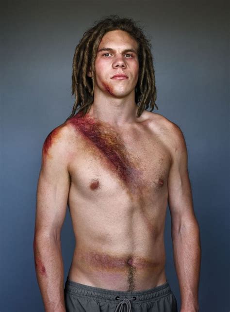 10 Powerful Pictures Of Car Crash Survivors Who Want To Raise Awareness ...