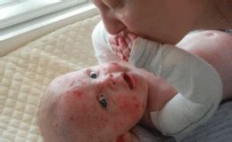 Epidermolysis Bullosa or Butterfly Children; A Look at the Skin Disease ...