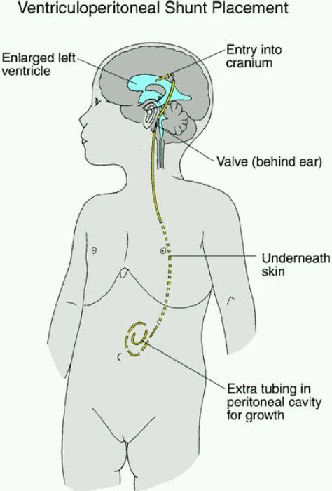 Shunt. I have one of these:) | Medicine | Child life specialist, Child ...